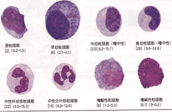 2,副原粒细胞:正常人不见,只有在急性粒细胞白血病或绿色瘤时常见.