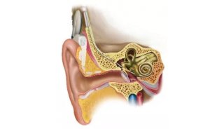 耳蜗植入术治疗全聋和重度听力下降，击破颅内的听障
