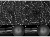 Eye：利用OCTA无损观测视网膜中央凹无血管区（FAZ）中难以测量的小尺寸区域