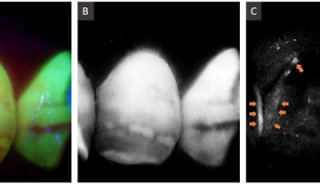 OCT和自荧光成像系统进行牙科非侵入性多模成像